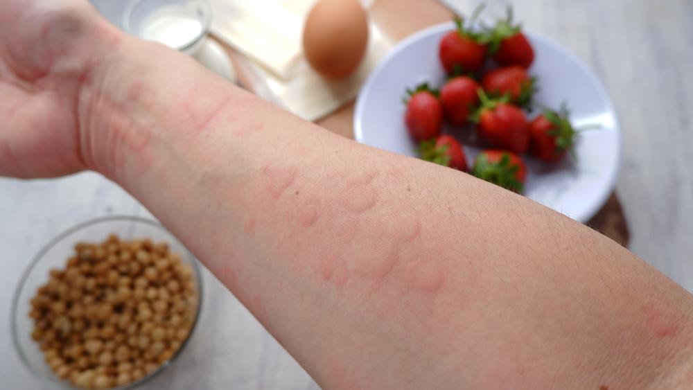 Uitslag allergie eczeem