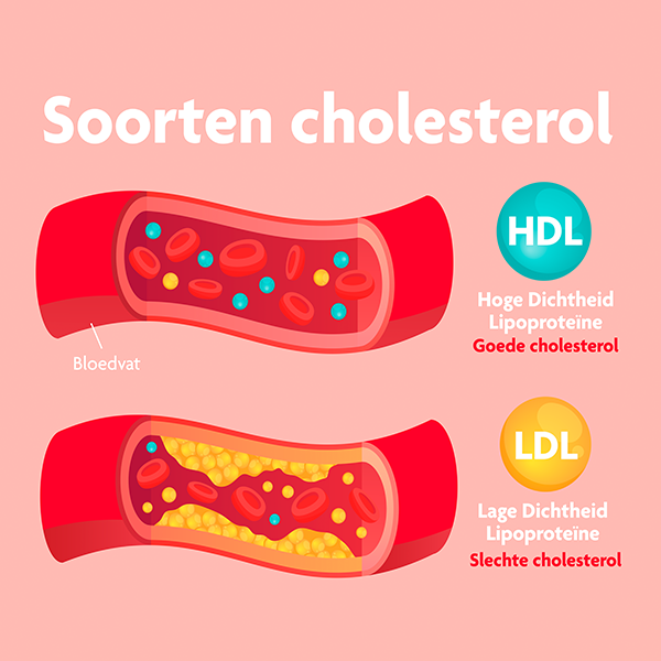 Voorbeeld van goede en slechte cholesterol